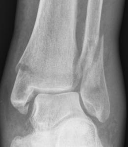 ankle fracture 1