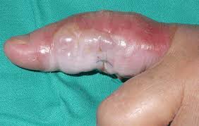 image - finger infection