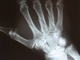 metacarpal