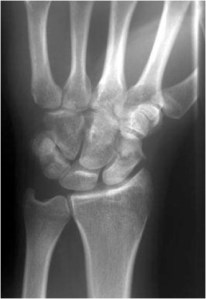 Scaphoid Image1